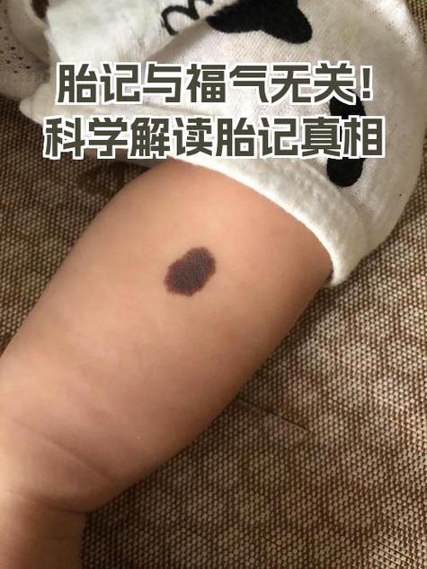 女人右肩胎记命运如何？这胎记预示着什么？