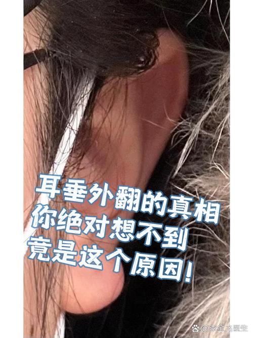 耳垂外翻与耳珠朝口、耳珠外翻有何不同？