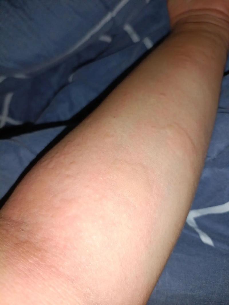 风水疙瘩会自己消失，还是需要采取措施才能去除呢？