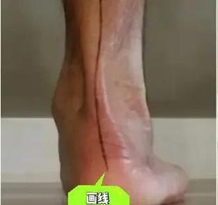 脚外翻的人命运如何？外八字是否等同于足外翻？