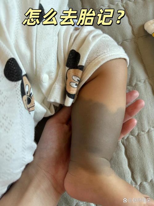 去除胎记对男孩的运势和风水有影响吗？