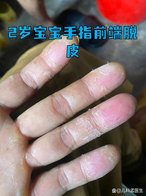 小孩手粗糙是预示什么命运？手特别粗糙是何原因导致？