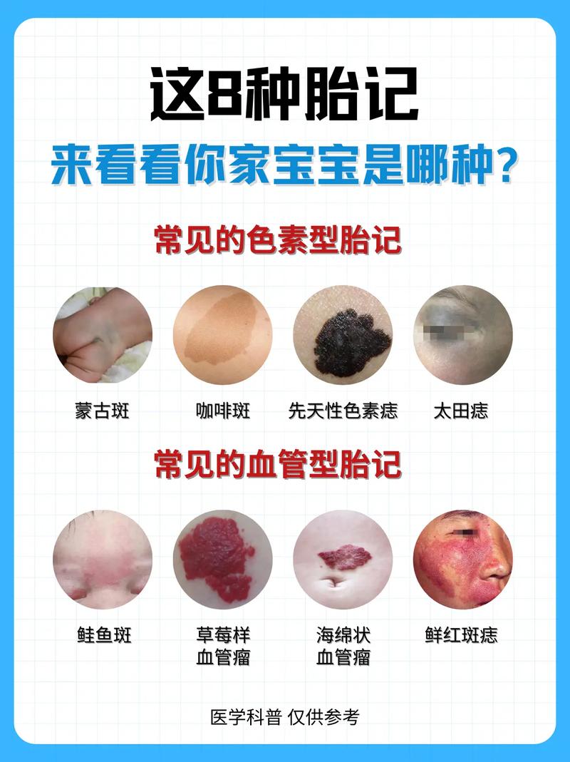 左胳膊胎记命理含义是什么？