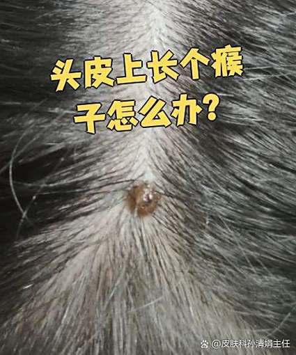 后脑勺长瘊子是什么命？