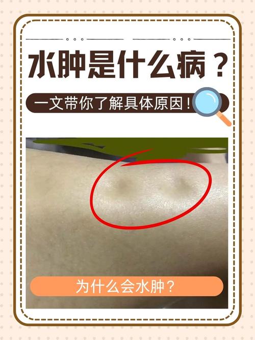 风水水肿是否包含在水肿的范畴之内？