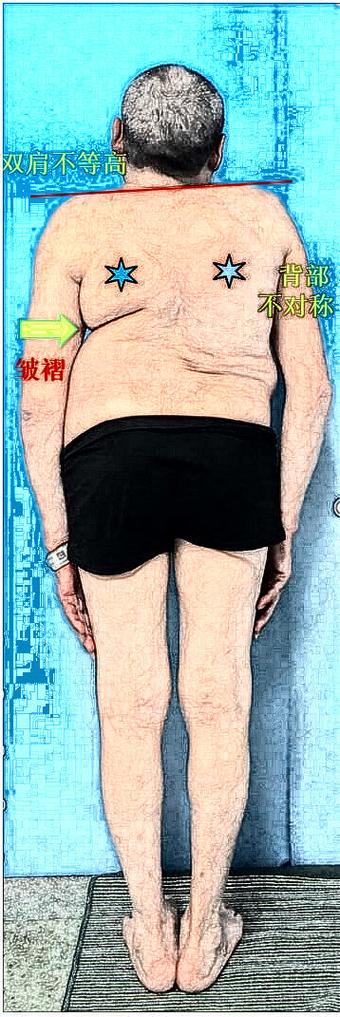 后背罗锅的人命运如何？罗锅是如何形成的？