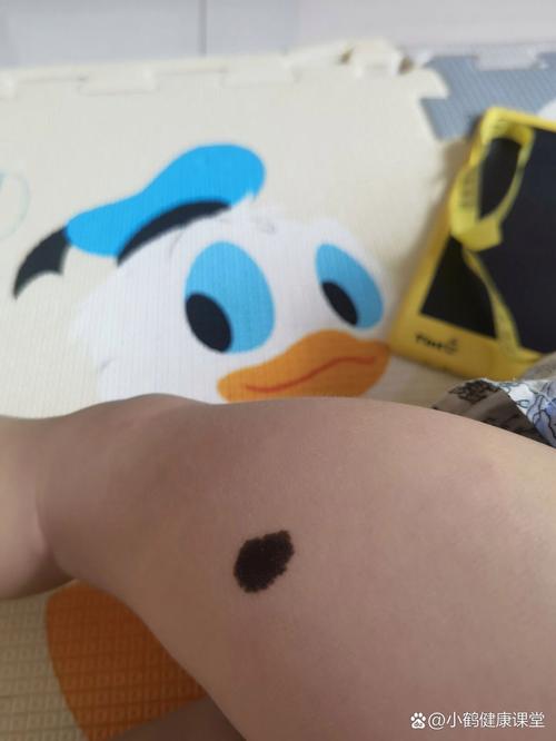 大腿根部胎记影响命运吗？如何改善腿部胎记？