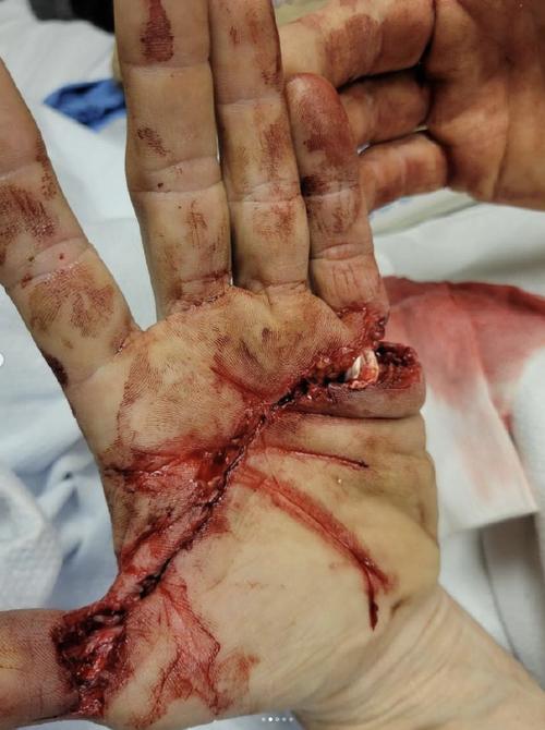 手指被砍掉会是什么命运？用刀剁手指头会危及生命吗？