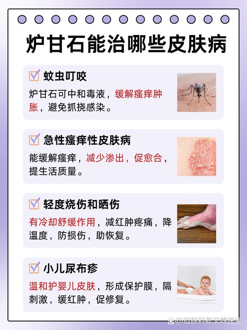 风水疙瘩可依用炉甘石涂抹吗？哪种情况下适用？