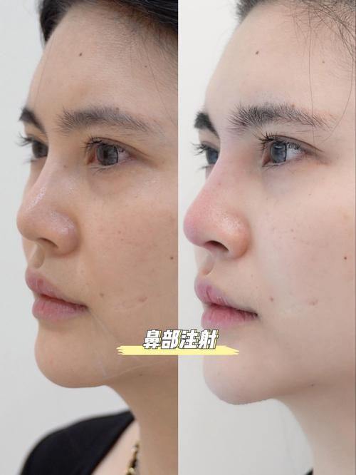 鼻子注射玻尿酸会影响家居风水吗？