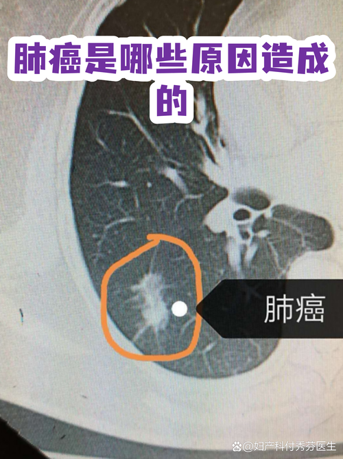 肺癌的发生与住宅风水环境之间是否存在关联？