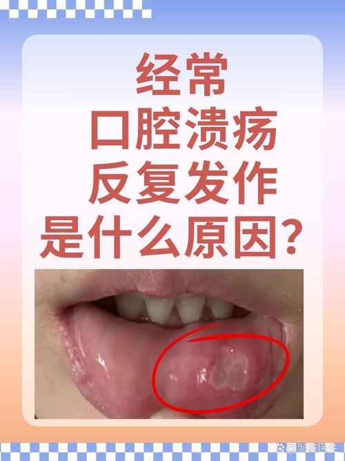 口腔溃疡与风水之间是否存在某种关联？