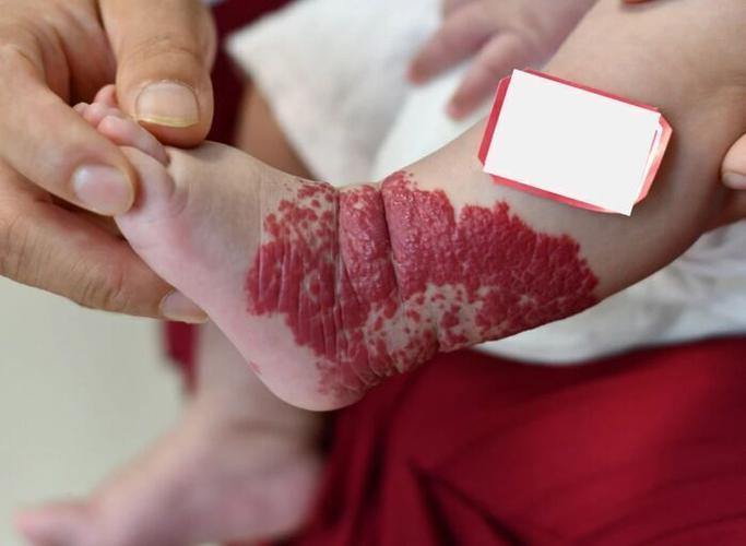 脚上红色胎记预示着怎样的命运？老说法中脚上红胎记的寓意是什么？