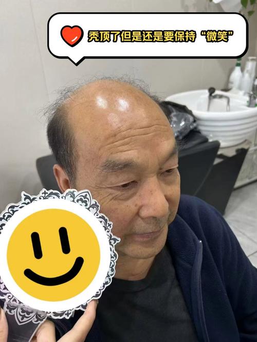 中年秃头是何命格？头发多的人命运是否多舛？