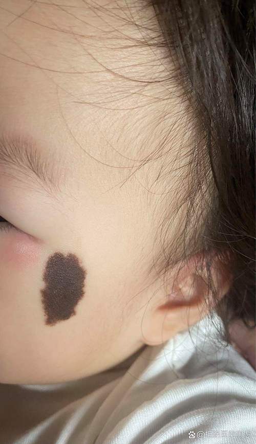 眼睛周围胎记代表什么命运？贵子胎记出现在六个部位有何特殊含义？