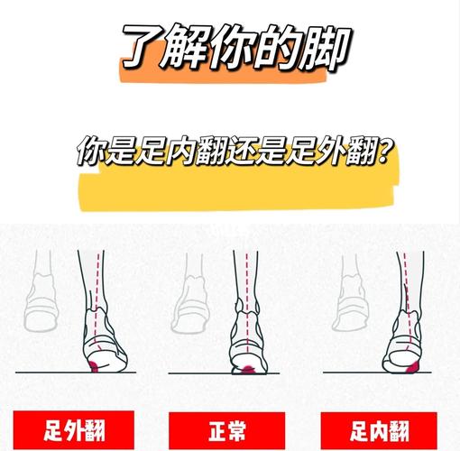 脚外翻的人命运如何？外八字是否等同于足外翻？