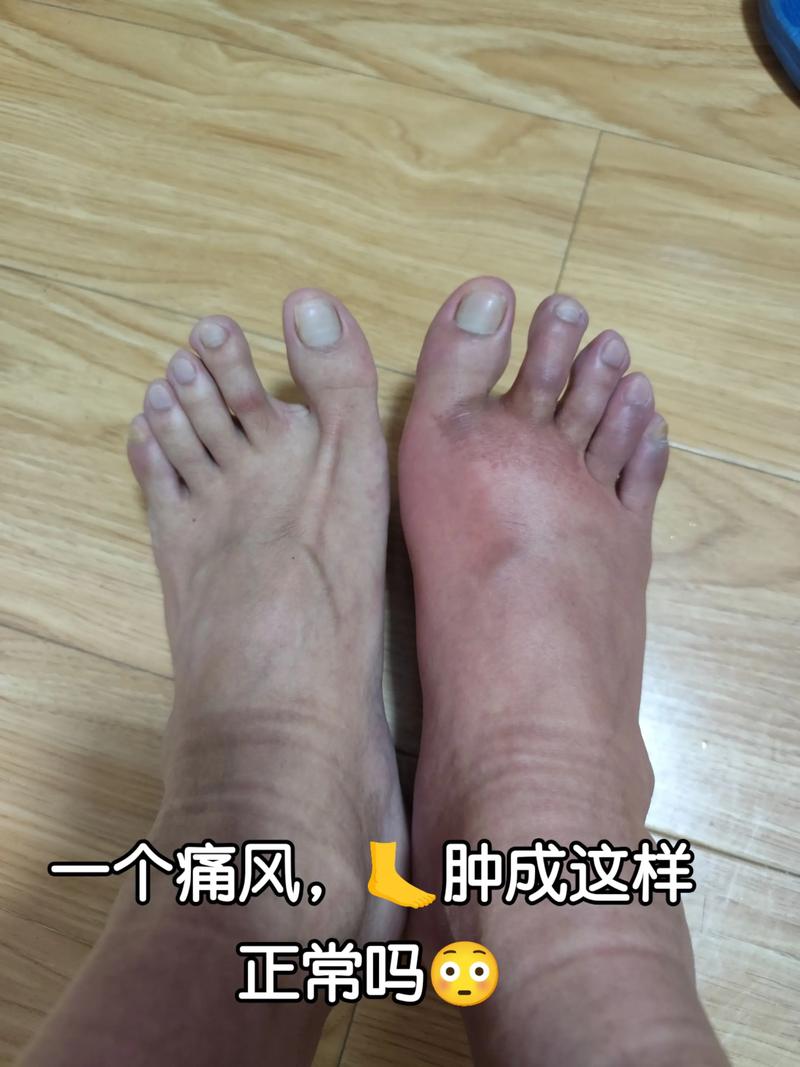 痛风水肿了还能洗个澡吗？