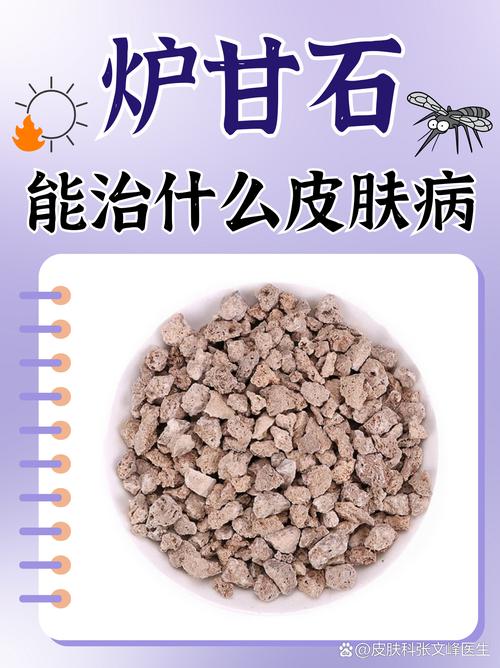 风水疙瘩可以用炉甘石涂抹吗？哪种情况下适用？