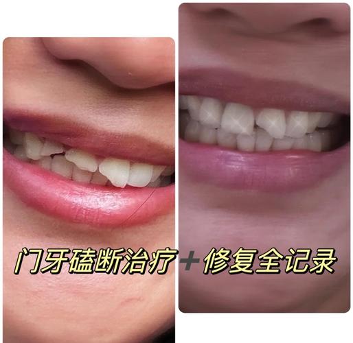 门牙整形真的能改变风水吗？这是真的吗？