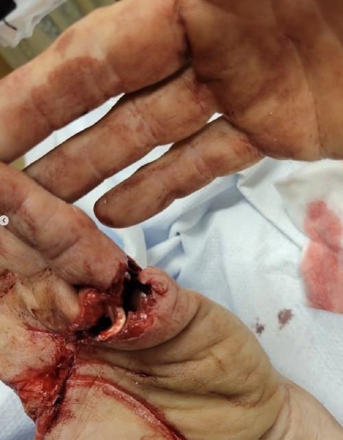 手指被砍掉会是什么命运？用刀剁手指头会危及生命吗？