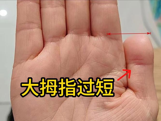 大拇指粗短的女孩命运如何？