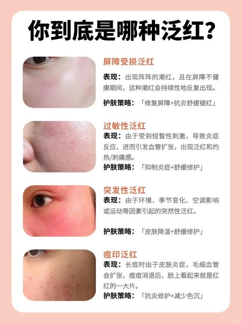 女人脸颊泛红是什么命理特征？脸颊两边常泛红是何原因？